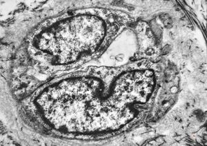 F,42y. | pseudoangiomatous hyperplasia F,42y. | pseudoangiomatous hyperplasia